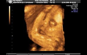 3d10 300x190 Hamileliğin (Gebeliğin) 18. Haftası