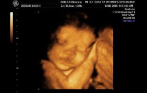 3d14 300x190 Düşük Hapı Düşük iğnesi Bebeği Nasıl Düşürür