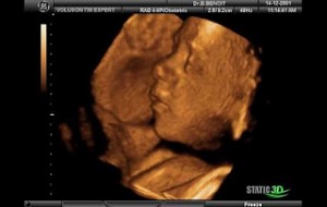 3d18 300x190 Bebeğin Cinsiyeti Ne Zaman Belli Olur