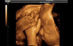 3d19 300x190 Akrep Burcu Anneleri ve Bebekleri