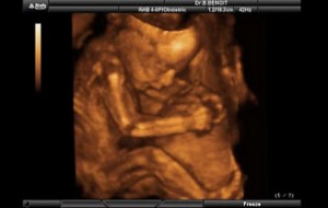 3d9 300x190 Hamileliğin (Gebeliğin) 13. Haftası