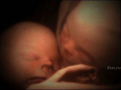 İkiz Bebek Hamileliği - www.hamilelikte.com