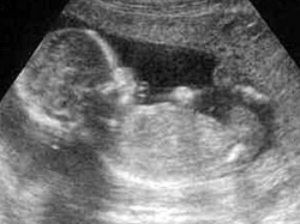 Ultrason Bebeğe Zarar Verir mi ?