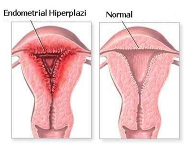 Endometrium kanseri belirtileri ameliyatı ve tedavisi