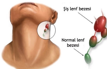 Lenf Düğümlenmesi Problemi Tedavisi Nedir