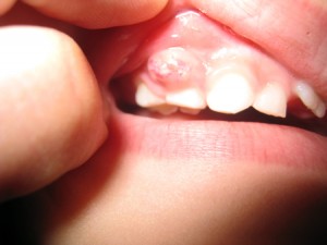 Diş Eti Rahatsızlıklarından Kurtulmanın Doğal Yolları Nelerdir?