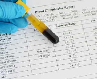 Bilirubin Direkt Yüksekliği Nedir?