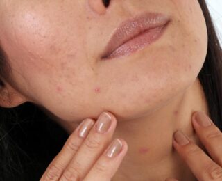 Hamilelikte Çenede Sivilce Cinsiyet